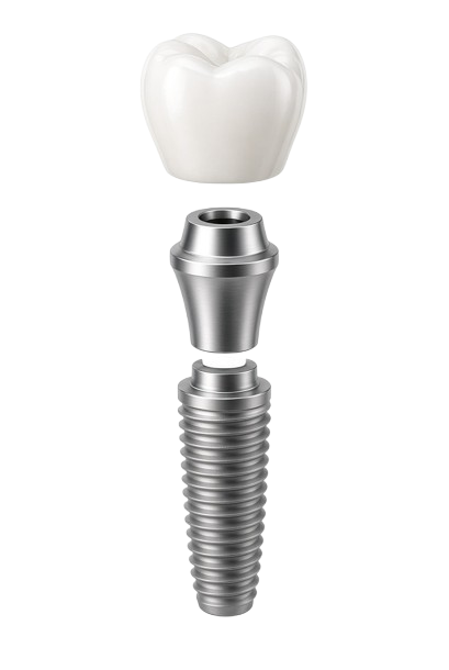 Implantes e Coroas